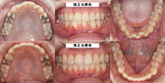 柏KT矯正歯科20代部分矯正症例