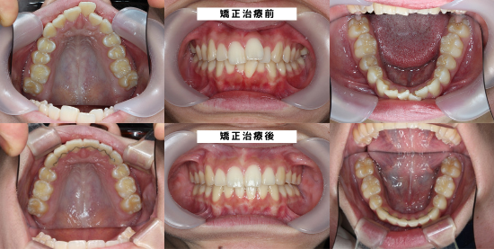 ならしのコウノ歯科・矯正歯科10代出っ歯矯正症例