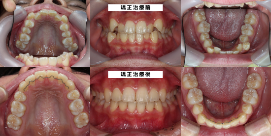 板橋歯科・矯正歯科10代凹凸矯正症例